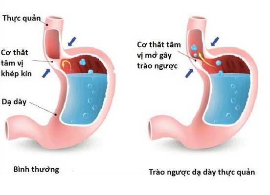 Hình ảnh co thắt tâm vị.